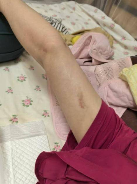 女子在陈清整形医学美容门诊抽脂失败 出现肠穿孔等22病症(图3)