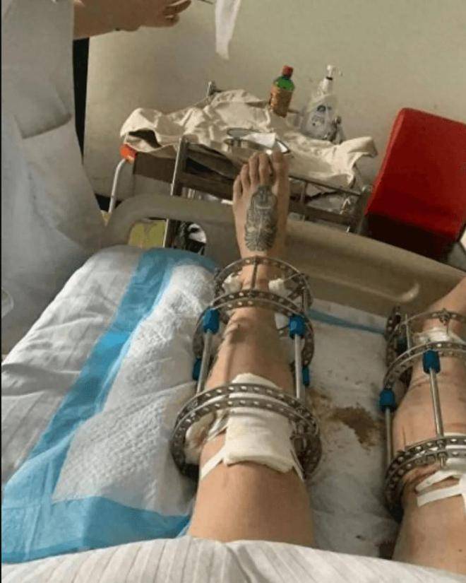 北京男孩李亚诺,曾花16万进行断骨增高的手术,如今怎么样了?