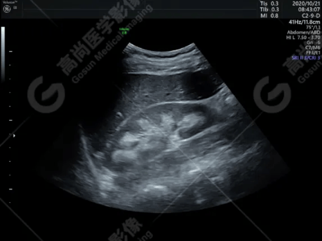 37岁女性,髓质海绵肾