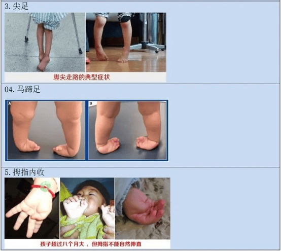 正确认识小儿脑瘫,越早治疗越好