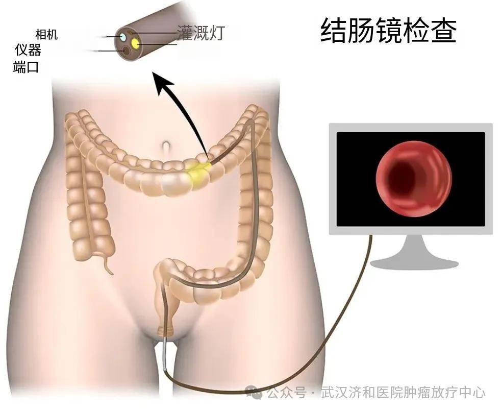 女生肠镜看光图片