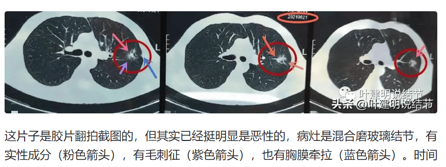 体检无提示不久后确诊肺癌 男子质疑爱康国宾存重大疾病漏诊(图1)