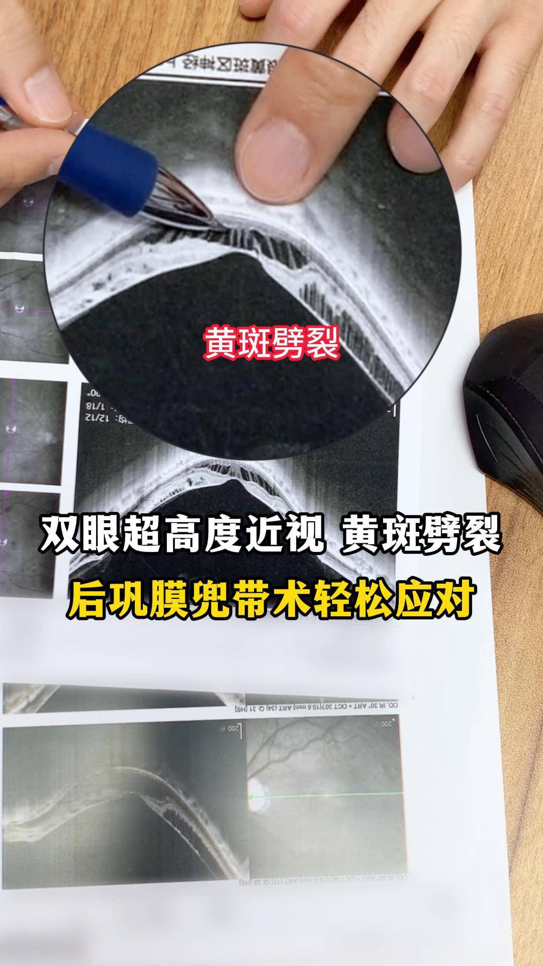 双眼超高度近视伴黄斑劈裂,后巩膜兜带术如何应对