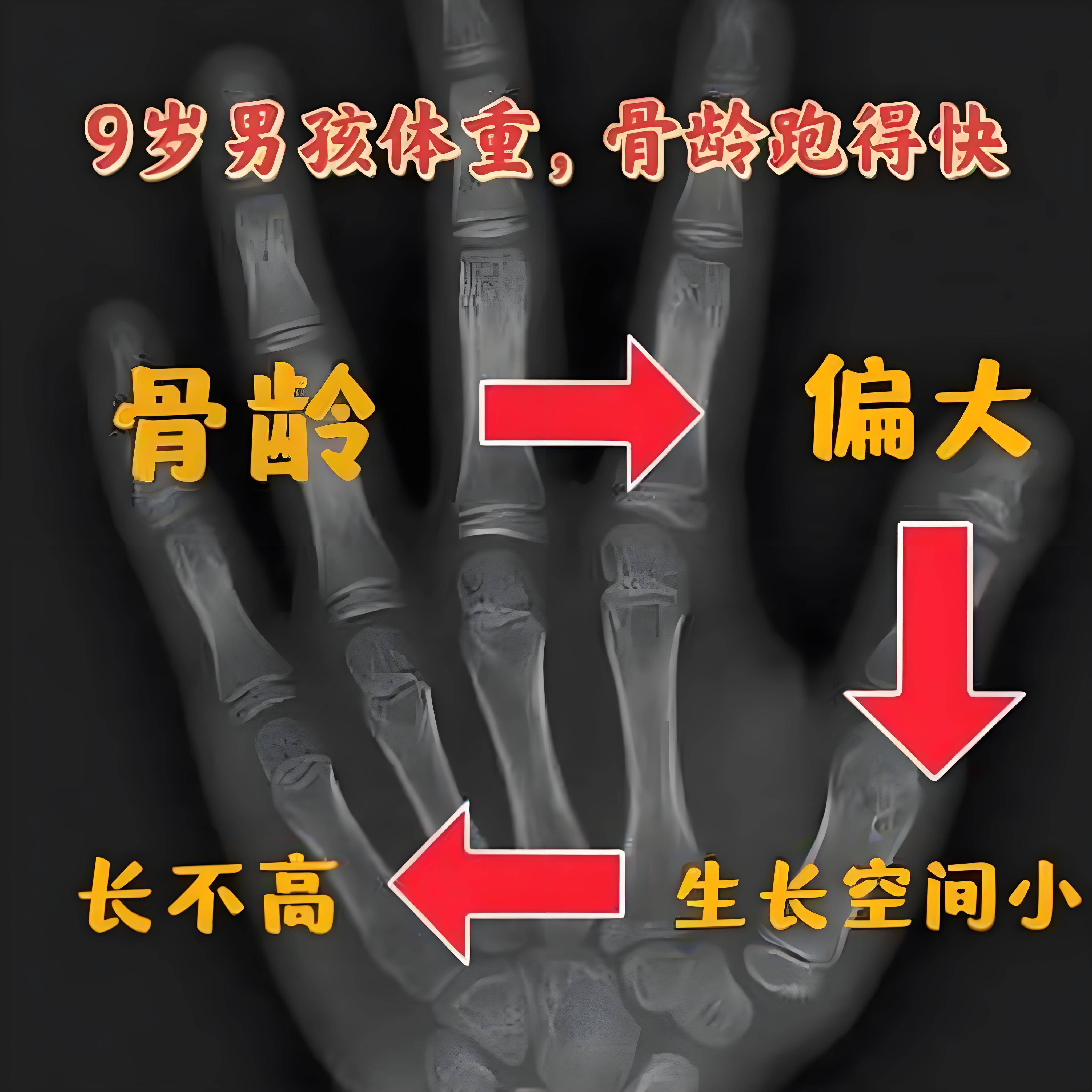 骨龄偏大不是天塌了!合肥天使儿童医院李辉主任:3个方法有效控制骨龄
