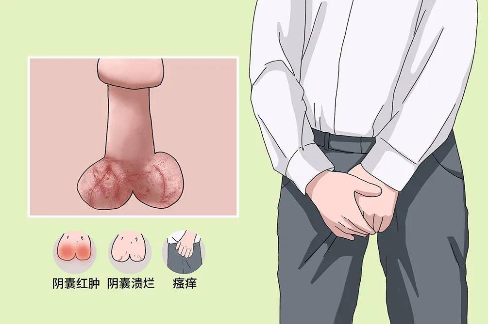 阴囊潮湿是种病