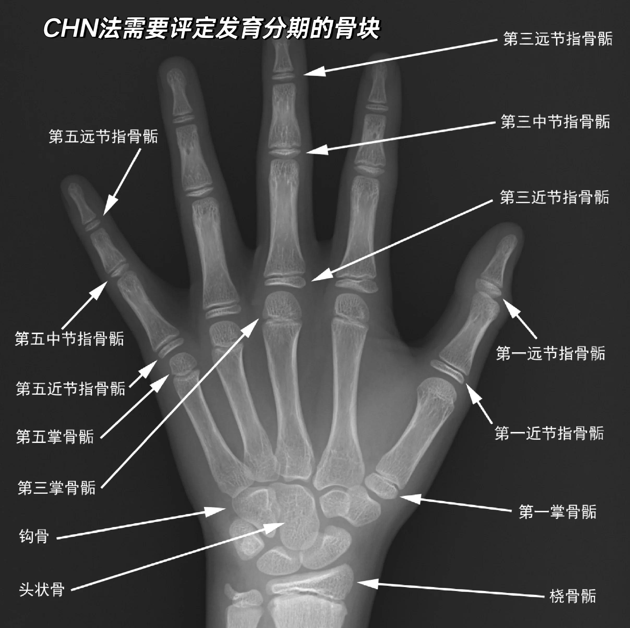 骨骺线:是长骨两端的软骨组织,是骨骼生长的 "生长板"