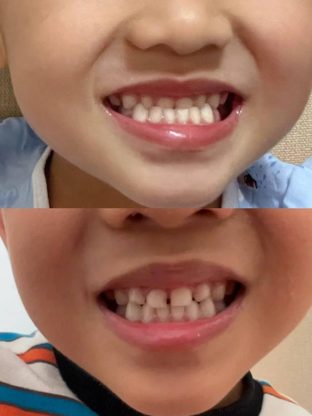 邢台地包天矫正要趁早:5岁小朋友骨性地包天矫正3个月效果明显