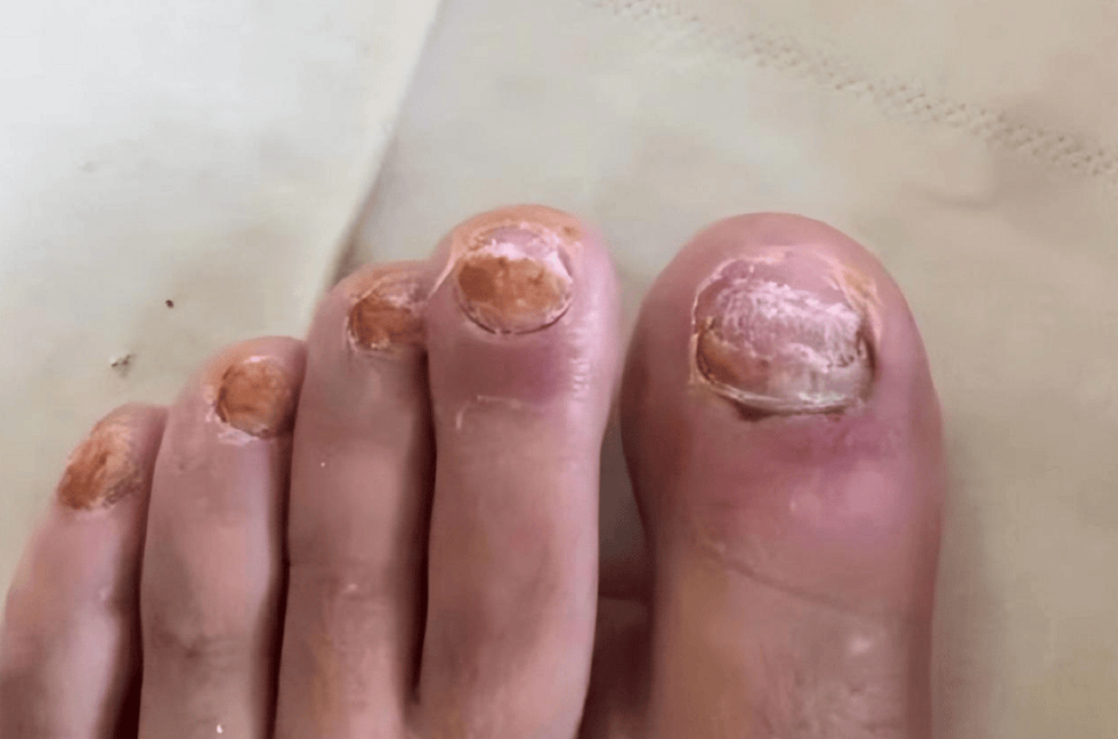 指甲泛黄增厚还掉渣!这个方法救我狗命!简单有用还省钱!