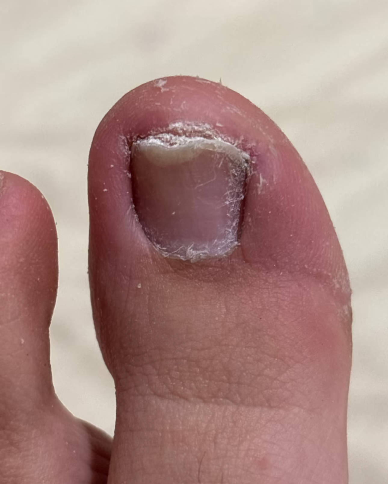 灰指甲好了仨月没再犯!好用的法子免费分享!