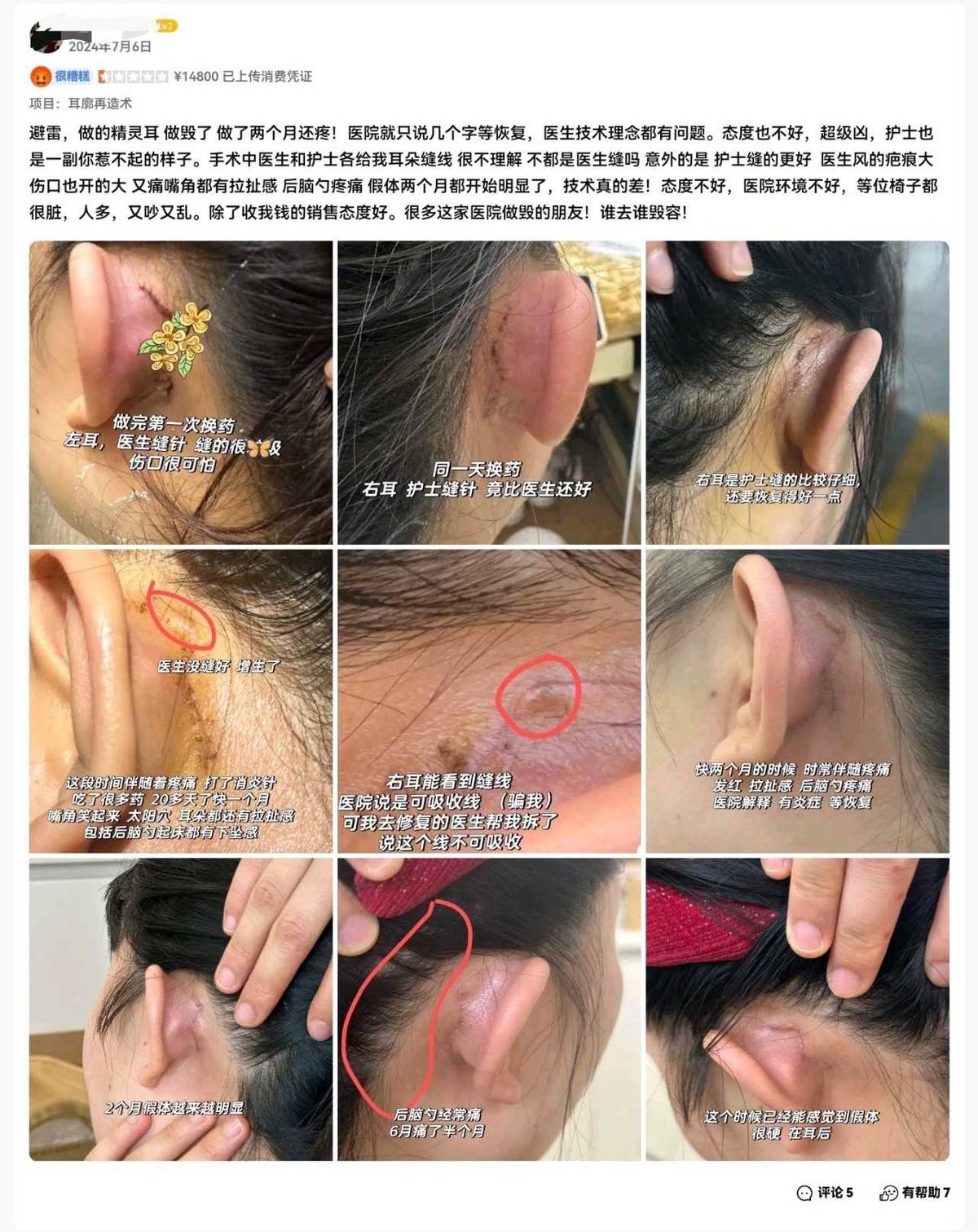 上海安禾美阁医美投诉实录:从鼻子发臭到眼睛无法闭合(图8)