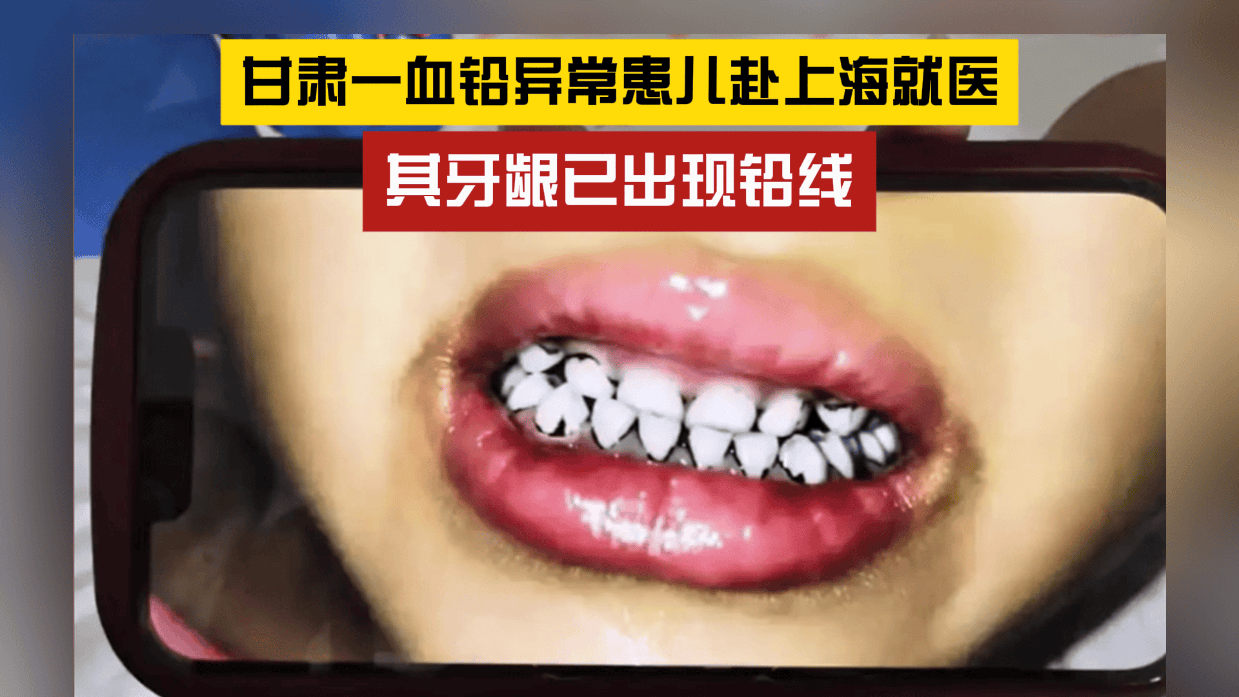 甘肃一血铅异常患儿其牙龈已出现铅线