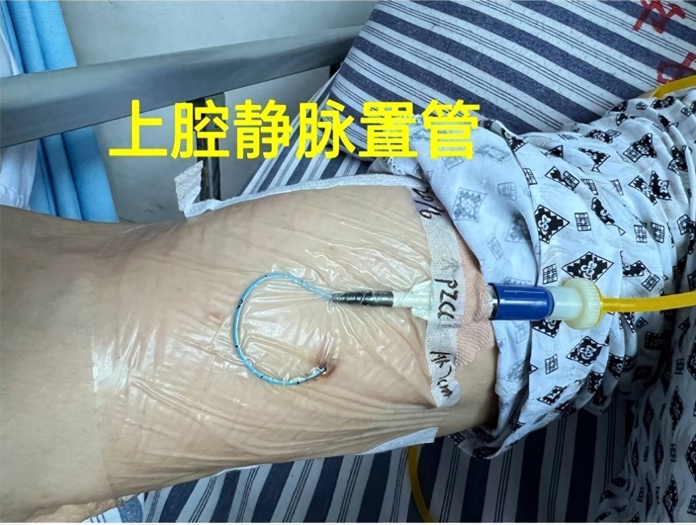 picc置管起到了保护静脉血管的重要作用