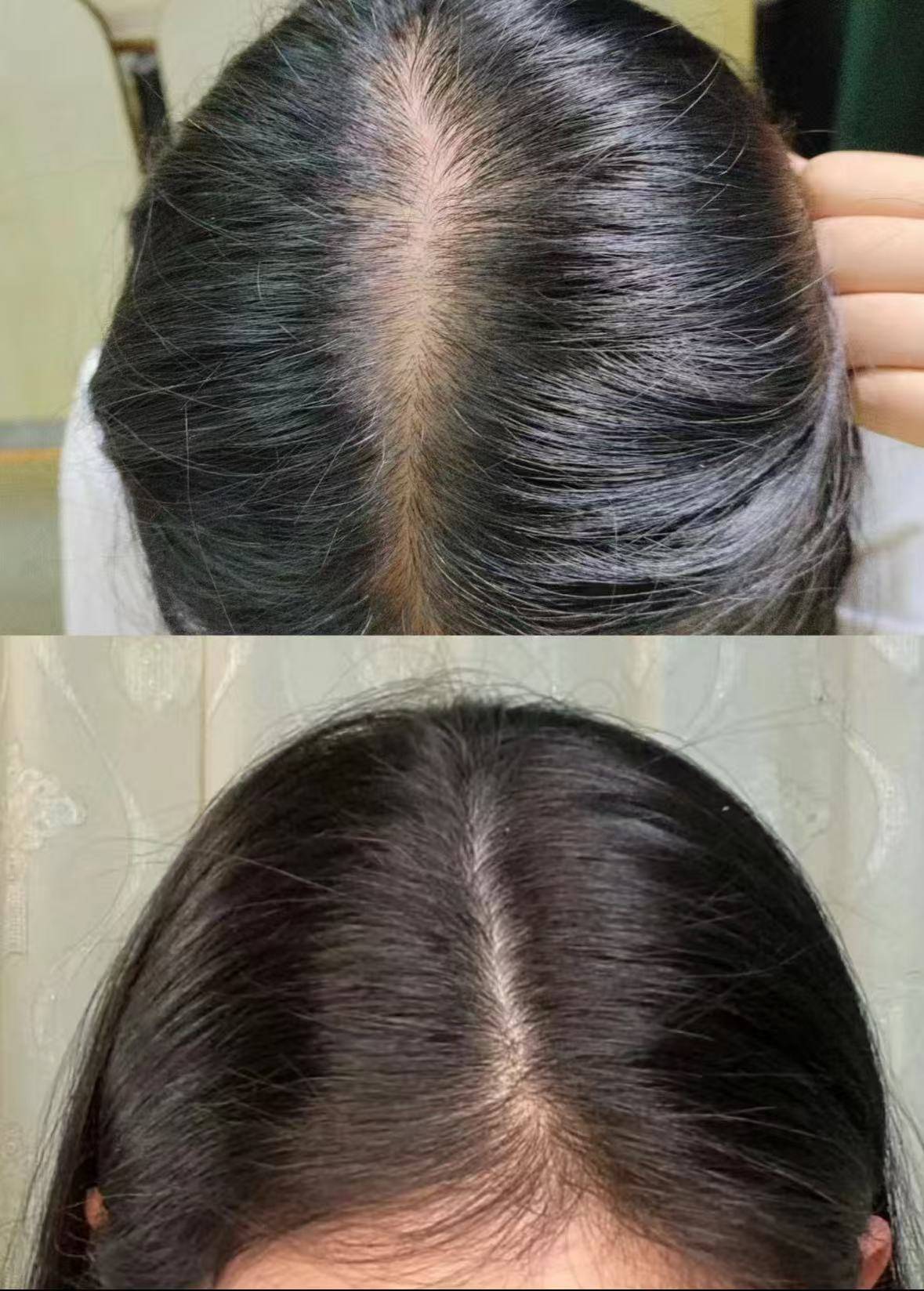什么防脱产品效果好?告别脱发危机排名第一的防脱生发产品推荐