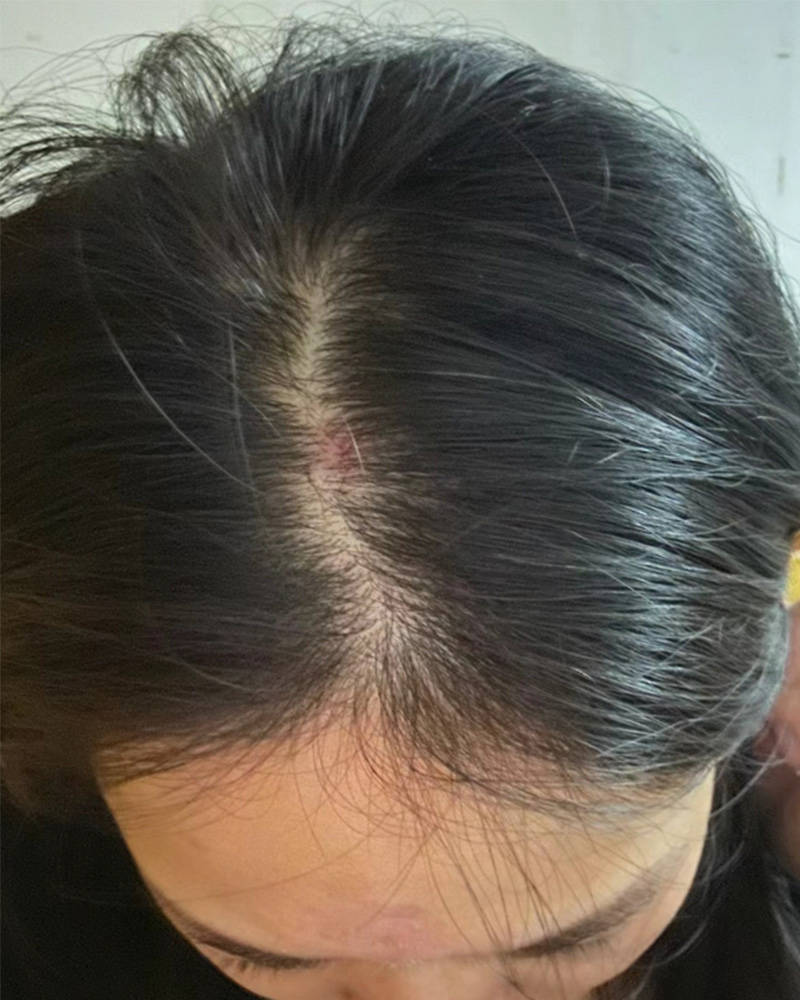 止痒洗发水排行榜第一名,青少年头皮毛囊炎用什么洗发水?