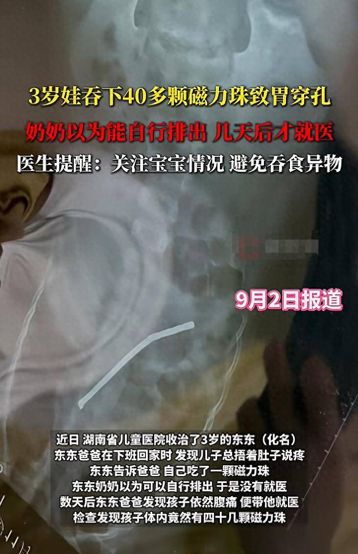 惊险!3岁娃吞下40多颗磁力珠致胃穿孔