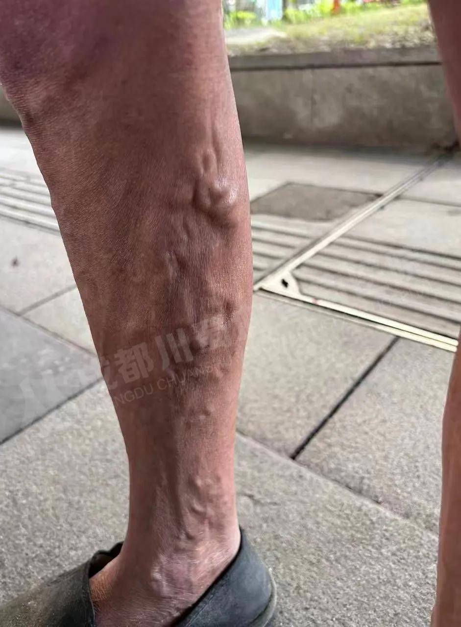 34岁酒店前台王女士腿上青筋凸起,酸胀,瘙痒:工作连轴转,静脉曲张的