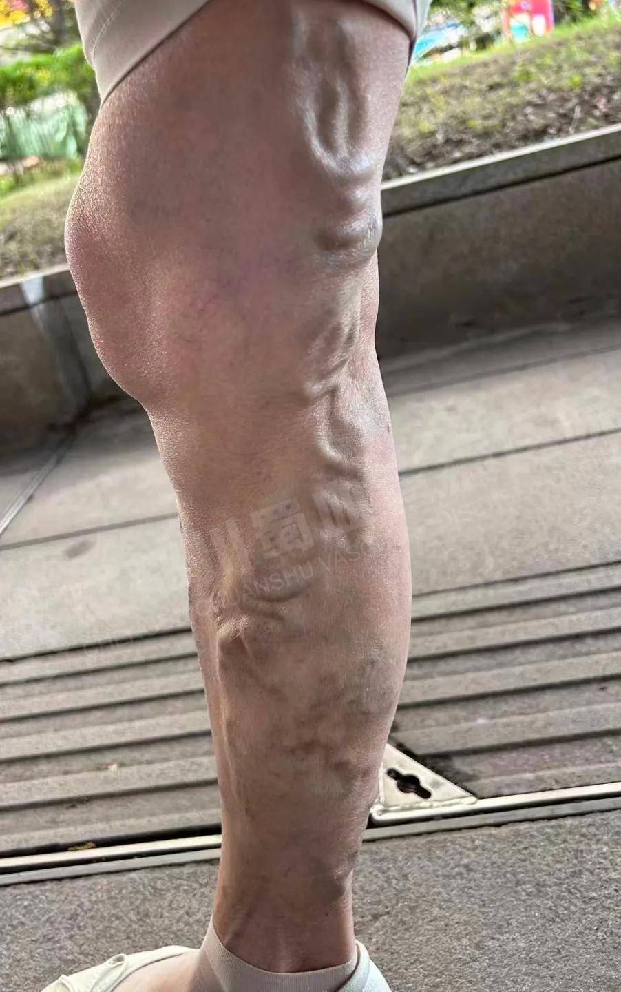 34岁酒店前台王女士腿上青筋凸起,酸胀,瘙痒:工作连轴转,静脉曲张的