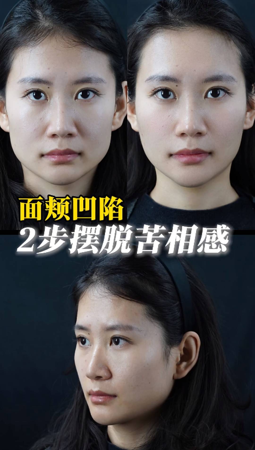 如何自然填充面颊凹陷?济南张敬花案例:从老态到年轻的蜕变!