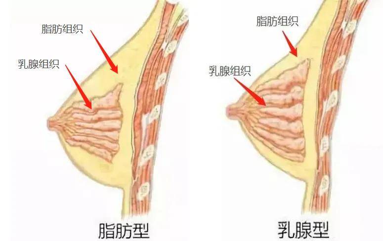 如何分辨真胸和假胸？隆的和真的一眼分辨