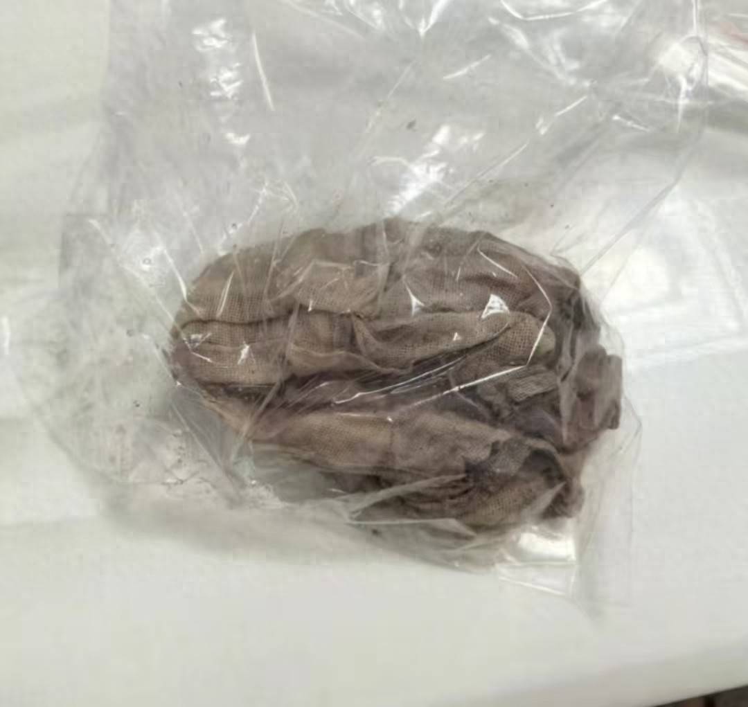 女子称邯郸中心医院剖腹产后纱布被留下体50多天 卫健委回应(图1)