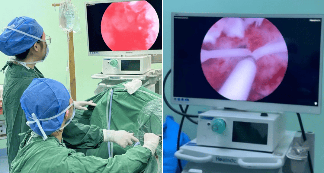 告别移位烦恼！宫腔镜下“盘扣法”让曼月乐环成宫腔“钉子户”