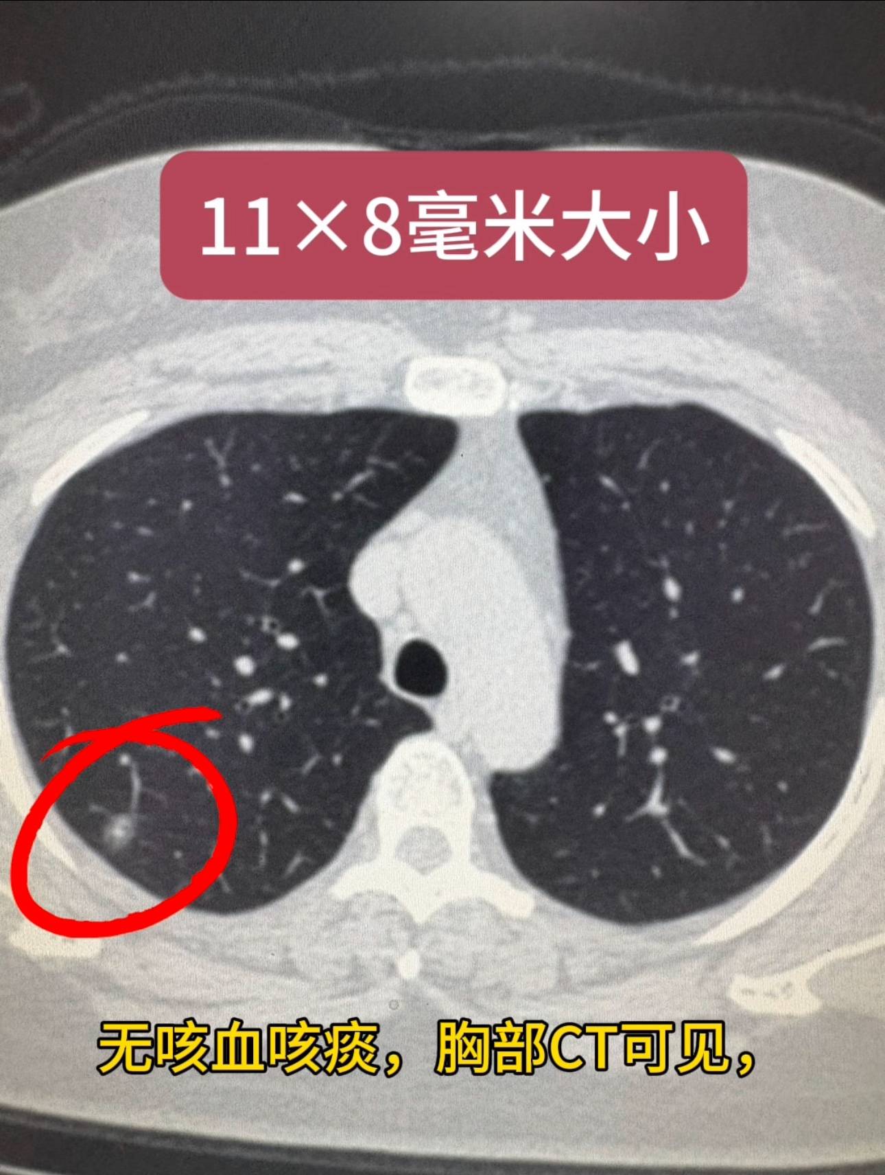 无明显咳嗽咳痰无咳血咳痰胸部ct可见右肺上叶后段第85层可见部分