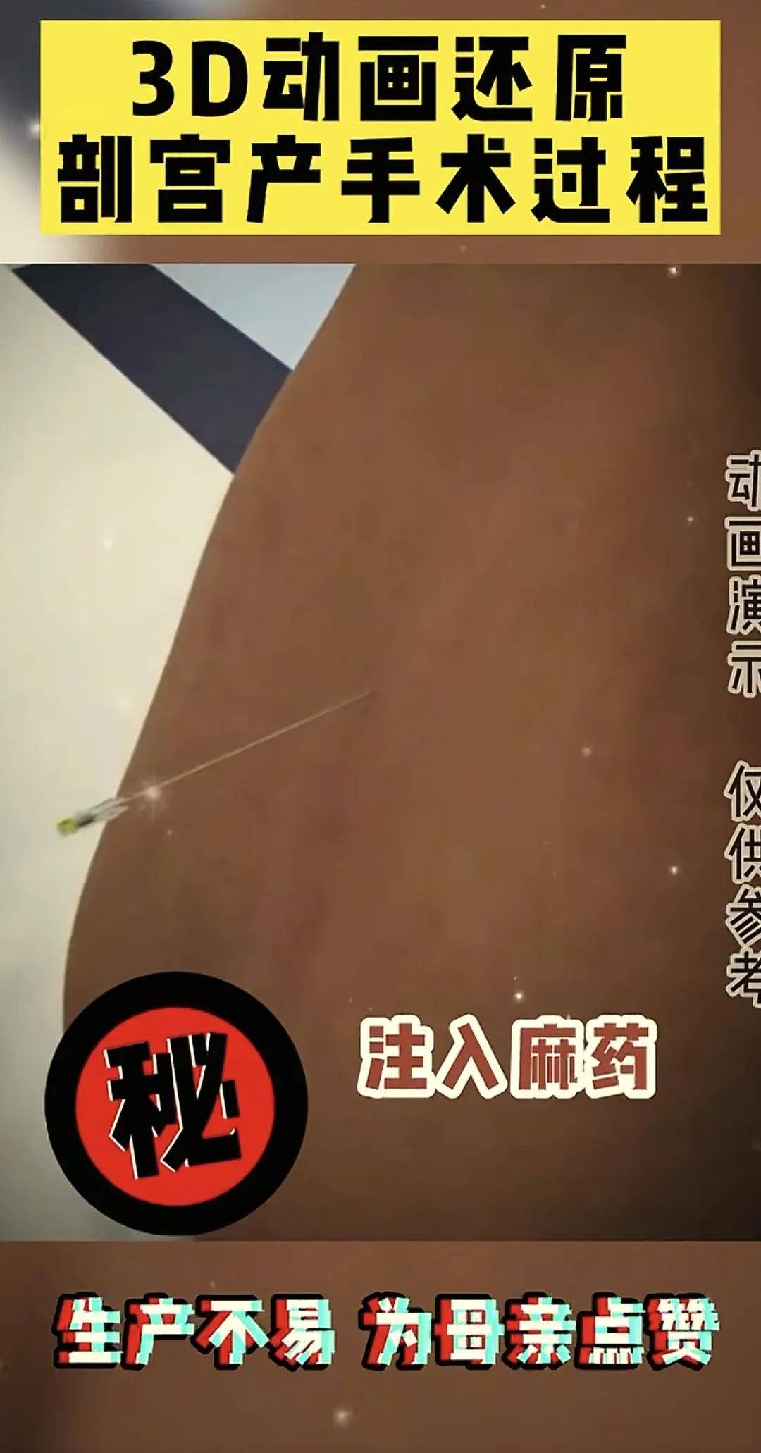 组图告诉你剖腹产有多痛？3d动画还原剖宫产手术过程