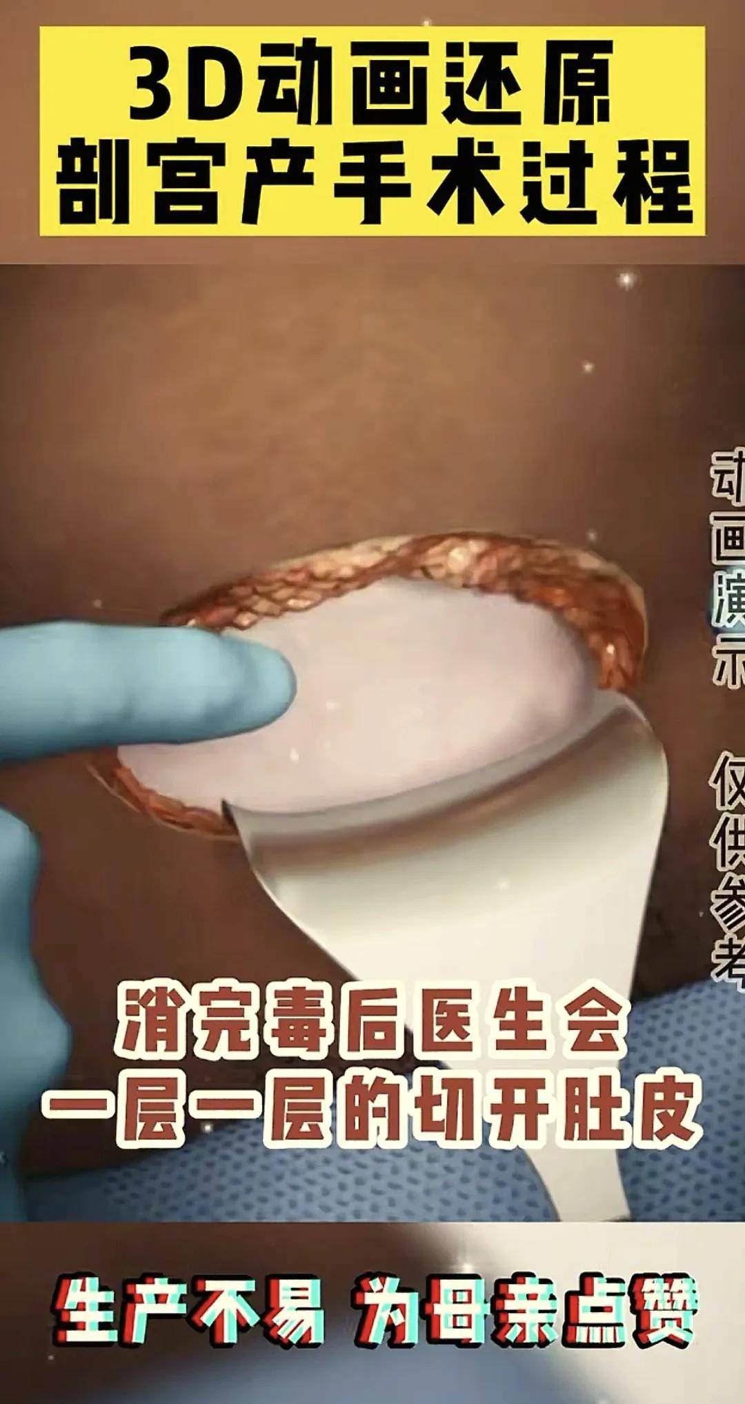 组图告诉你剖腹产有多痛？3d动画还原剖宫产手术过程