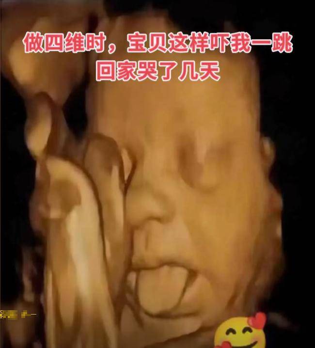 产检时B超里胖胎宝直吐舌头,老公直呼可爱！医生一句话让夫妻崩溃了