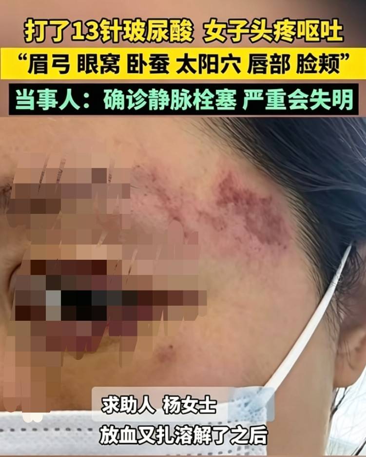 郑州悦己为学员注射13支玻尿酸栓塞 黑医美培训谁是受害者?(图2) 文章配图-1