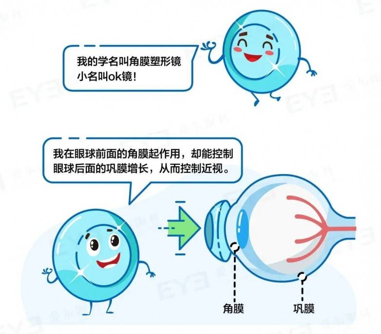 佛山爱尔眼科总院OK镜验配案例：7年追踪见证，青少年近视度数0增长如何实现？(图2)