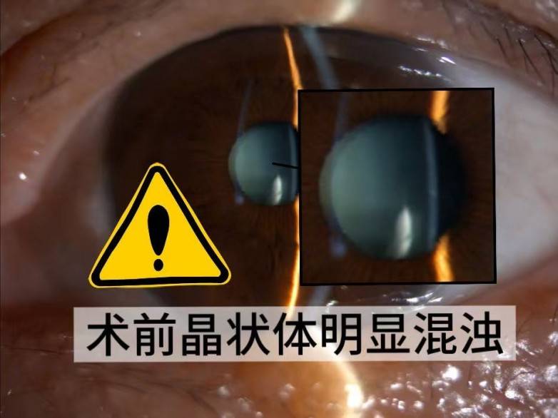 佛山爱尔眼科为7旬白内障患者植入双焦点晶体，术后视力从0.12提升至1.0+(图1)