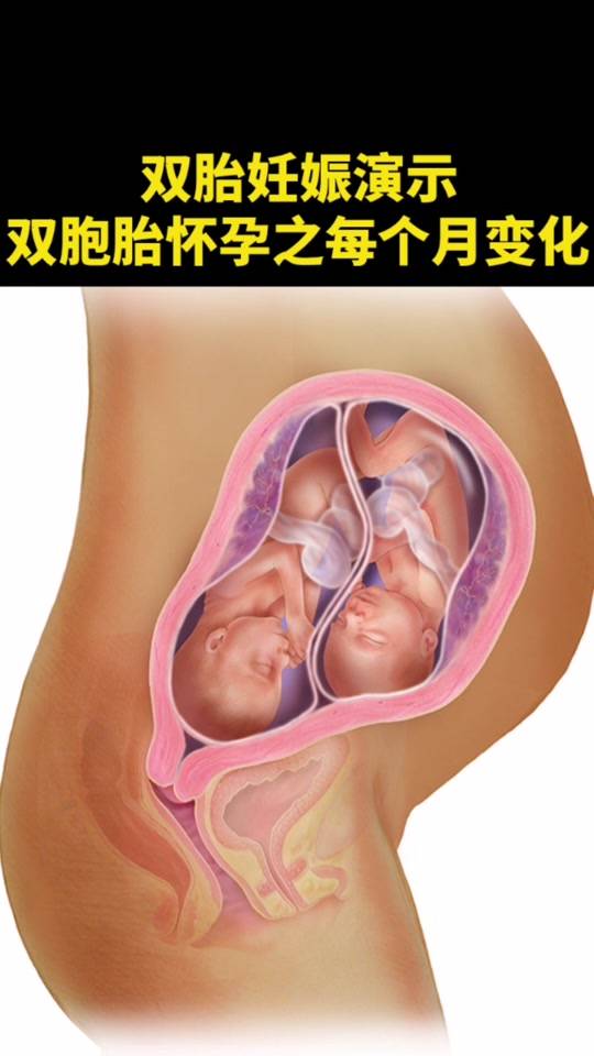 31周双胞胎孕妈眼睛突然看不清,脚肿,医生：等不了胎儿成熟,马上手术,再等就要