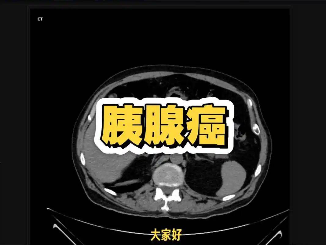 原创            华西医院：糖尿病不想变成胰腺癌，6种食物要少碰，饿也别吃