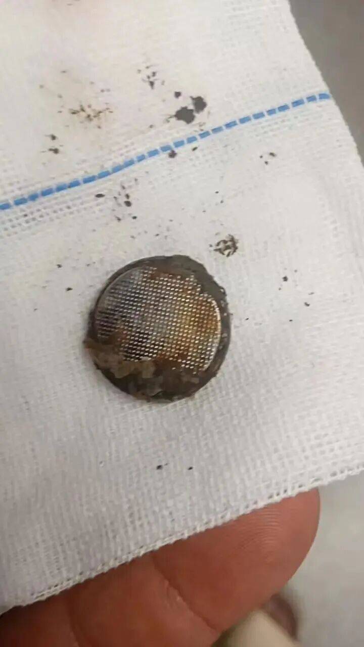 广东一女婴误吞纽扣电池26小时才被送医,食道被腐蚀、严重灼伤,医生提醒