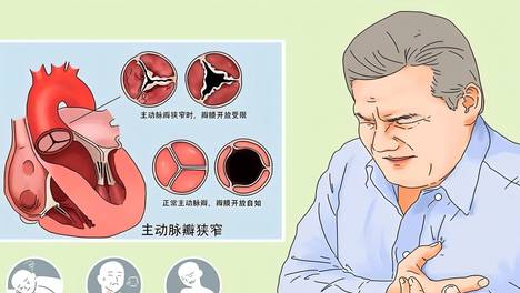 装上心脏支架，最好的调理方式是什么？