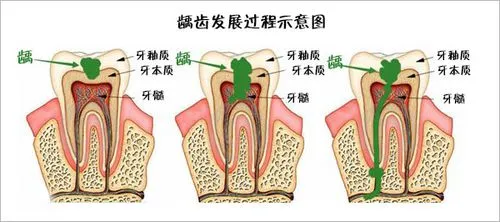 牙齿上面烂个洞怎么办_进行_治疗_口腔