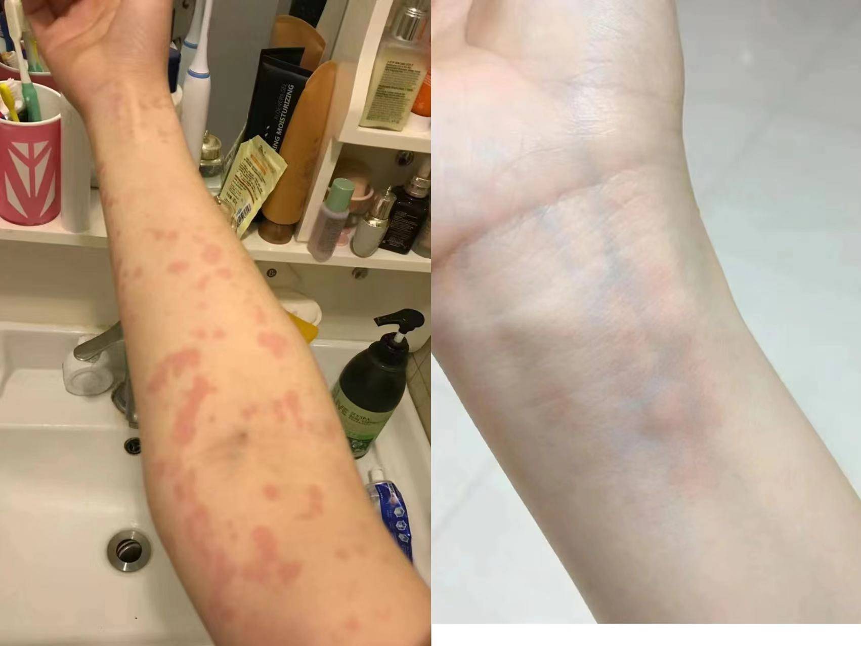 身上红疹瘙痒反复发作?