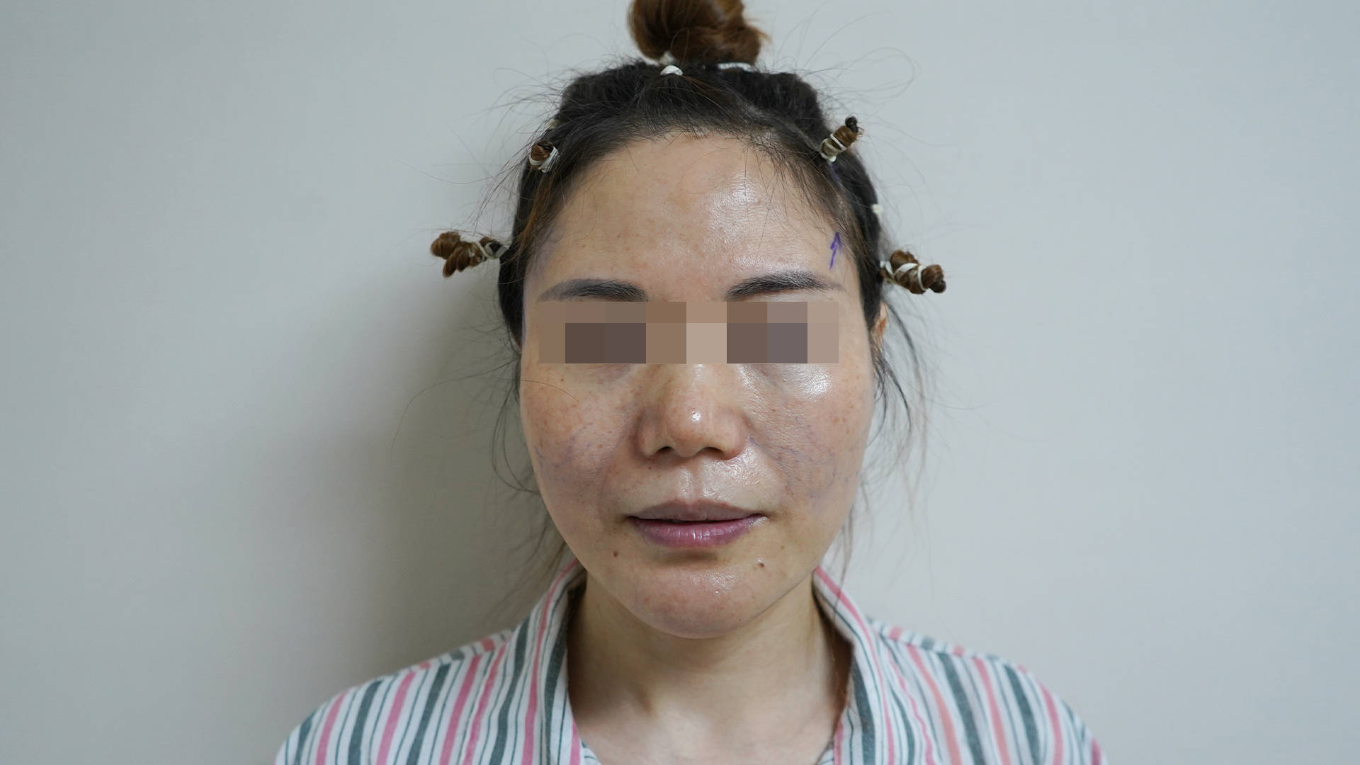47岁女士,从成都来北京做拉皮手术,术后肿成猪头,都急哭了!