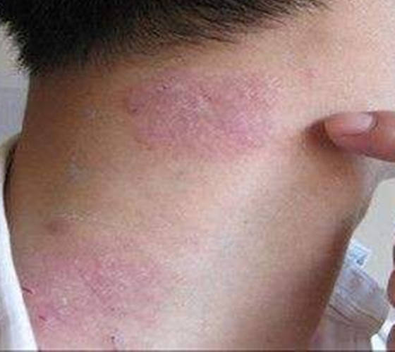 慢性湿疹是由急性与亚急性湿疹转变而来,此时的湿疹皮肤可能已经干燥