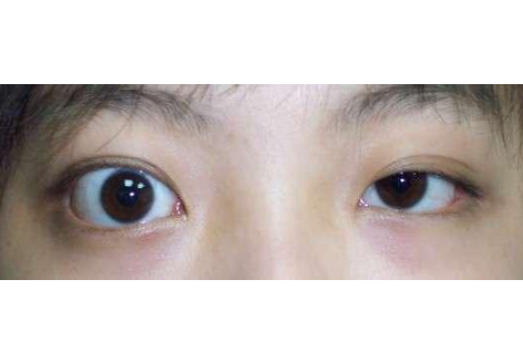 甲亢突眼患者,真的不能长时间玩手机,看电视吗?_严重_视力_眼球