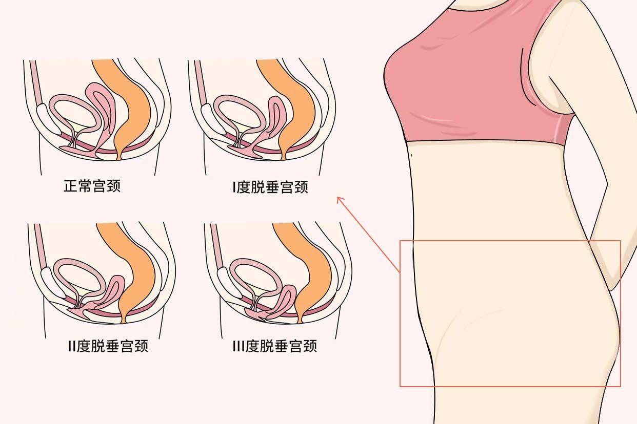 阴部前壁膨出症状图片