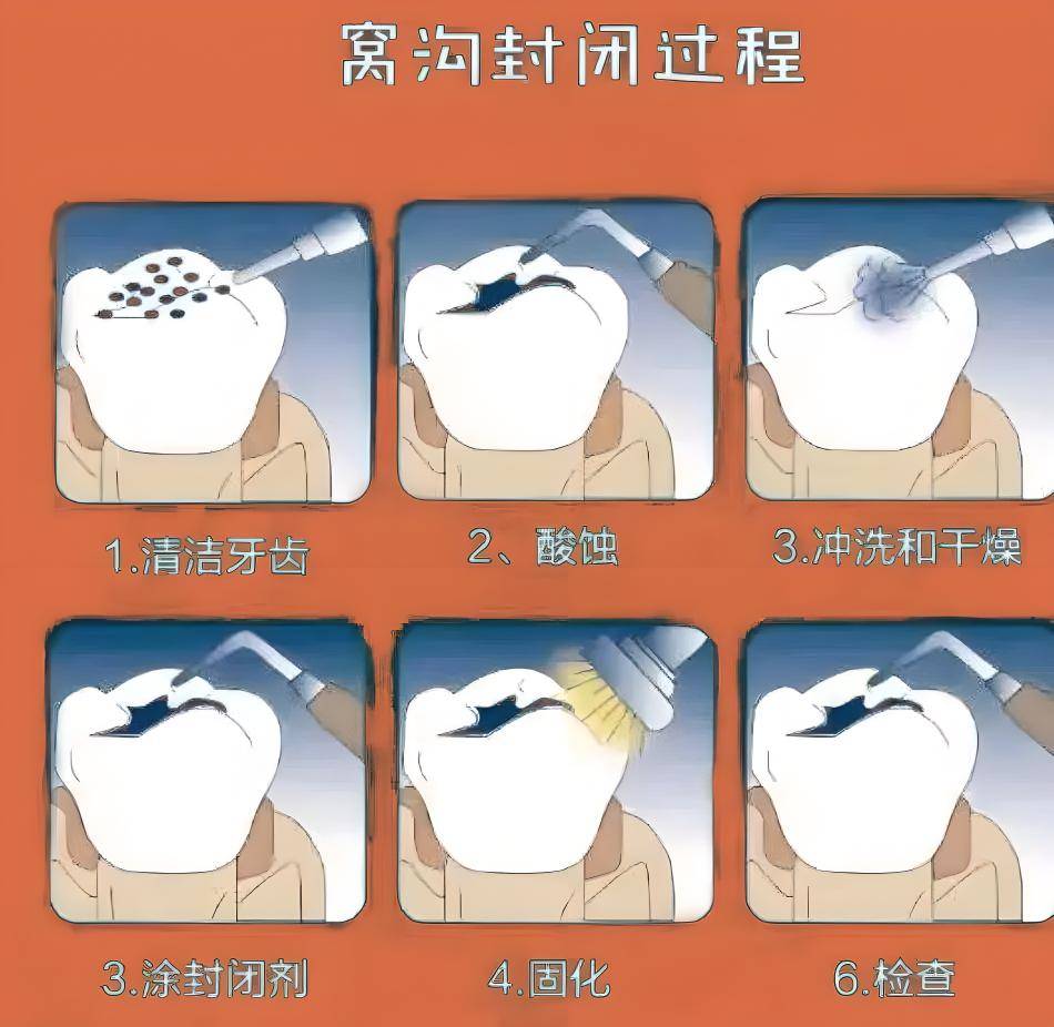 想问下多大的孩子可以做窝沟封闭?是不是在乳牙期只做一次就可以?