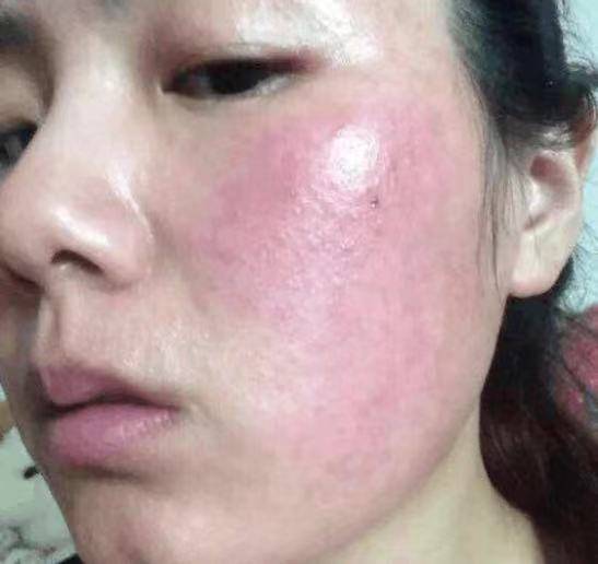 赶紧看看过来人护肤三步,轻松整没大红脸!