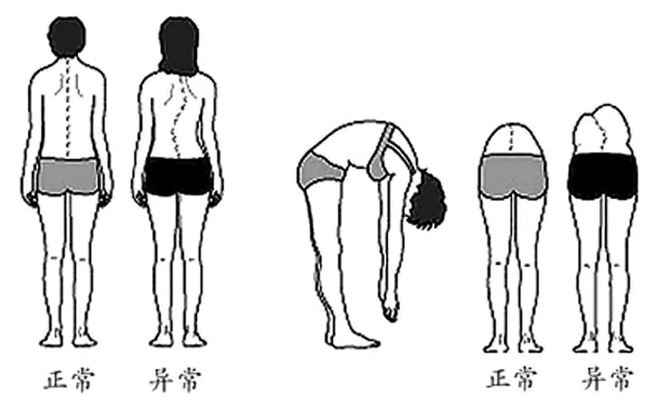 姿态,体态;观察青少年双侧肩,肘,骨盆,臀纹是否对称等高;足弓是否存在