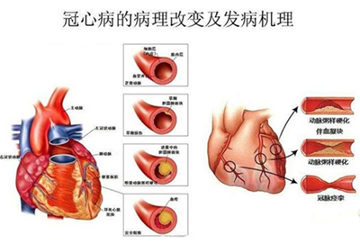 说对于冠心病患者,其在麻醉期可能发生冠状动脉的供血和心脏需血失衡