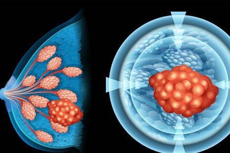 乳腺瘤与乳腺结节区别:广东药科大学复星禅诚医院肿瘤科潘静教授的阐
