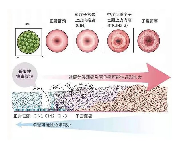 从hpv感染到宫颈癌到底有多远?