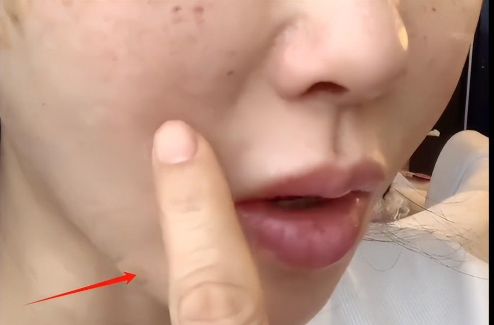 秦昊老婆跑韩国打水光针,56岁伊能静满脸针眼,直呼:真的很痛_网友