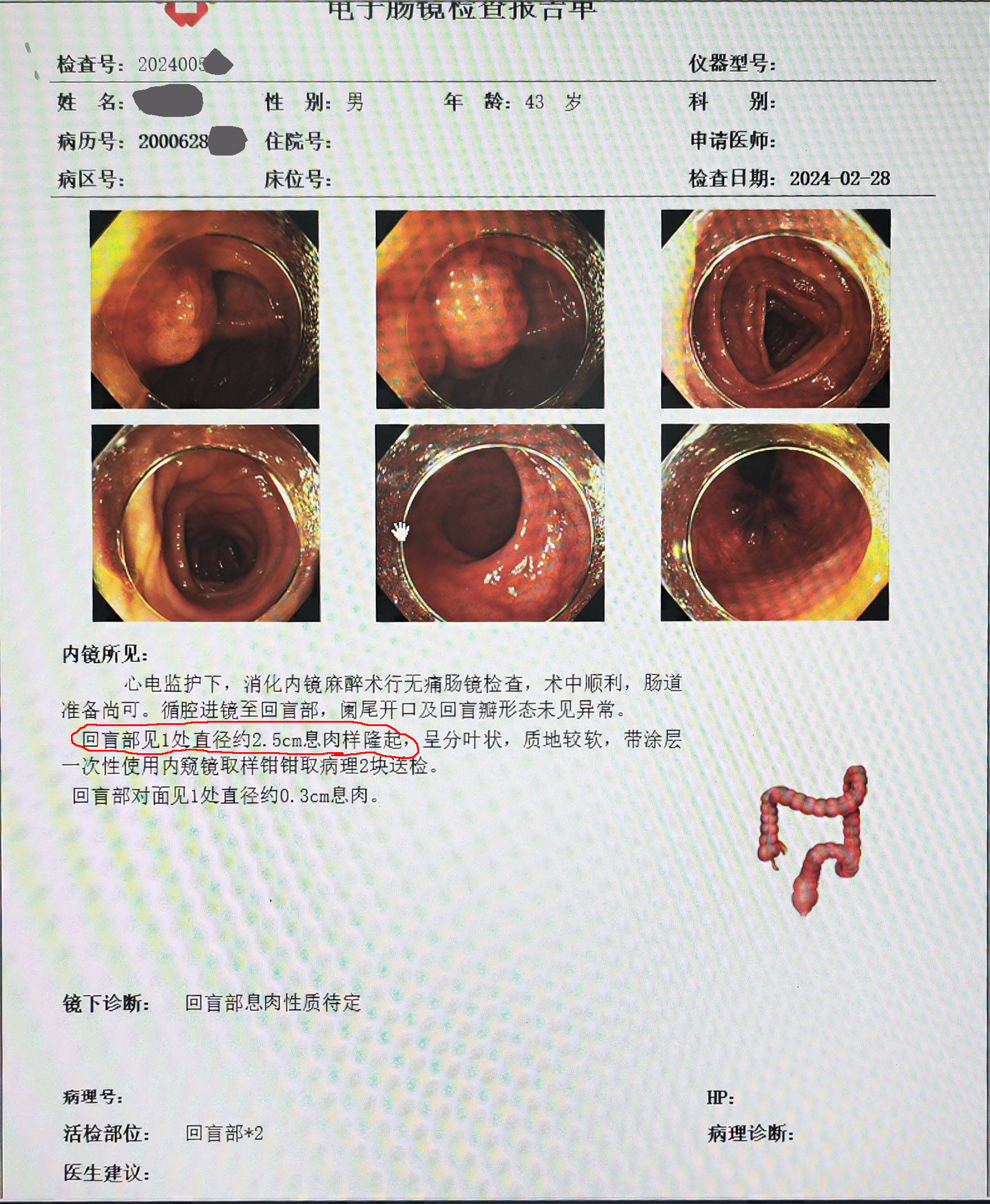 肠镜痛苦吗图片